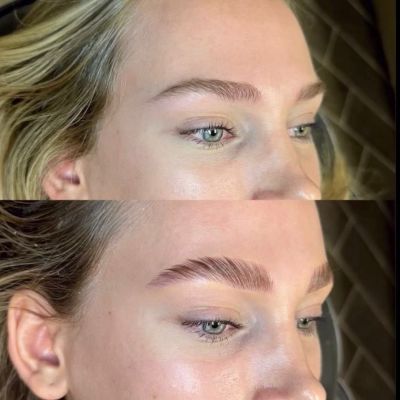 Brow Treatment